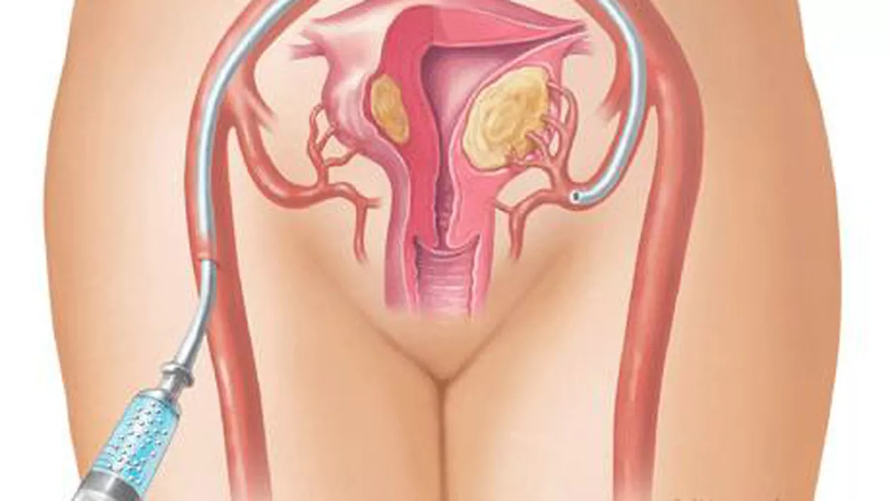 Embolizarea - abordare terapeutica noua in tratamentul fibromului uterin