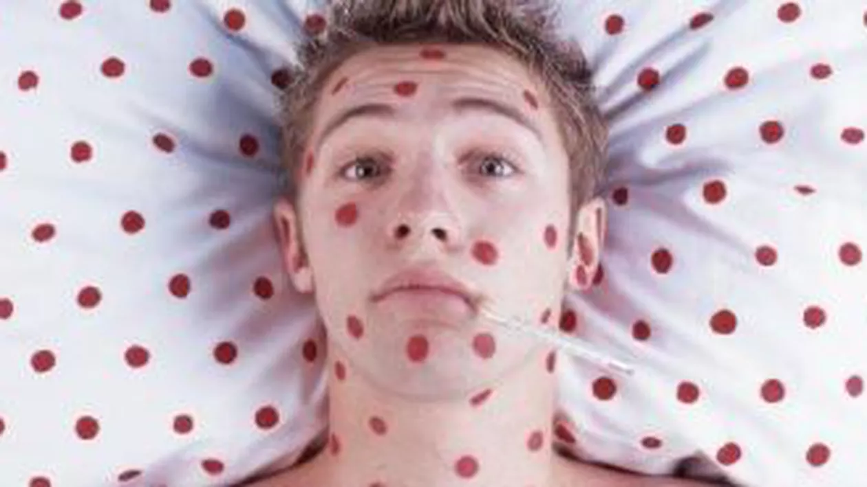 Suceava: Direcția Sanitară a înregistrat 135 de cazuri de rubeolă, majoritatea în Fălticeni