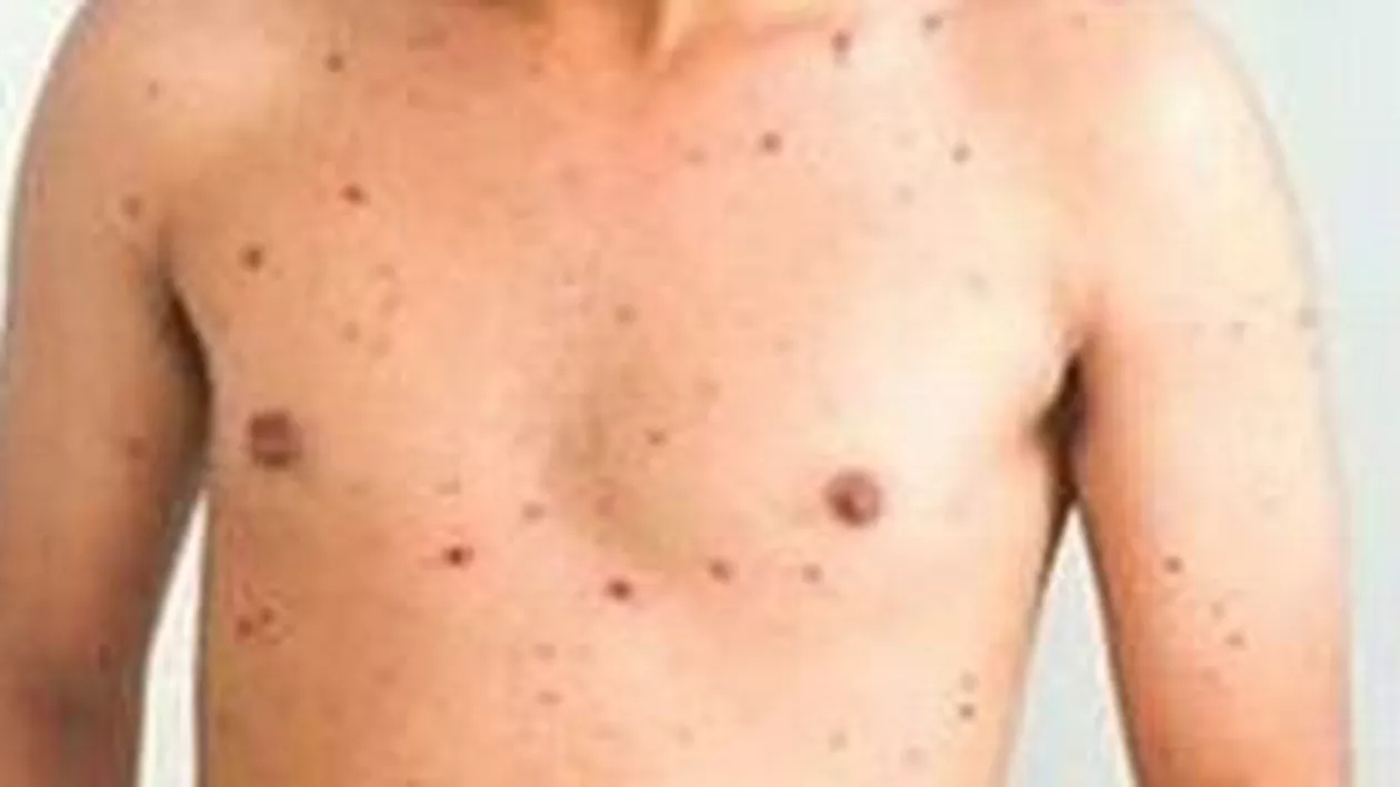 Sibiu: 12 focare de rubeolă, înregistrate în mai multe școli din județ