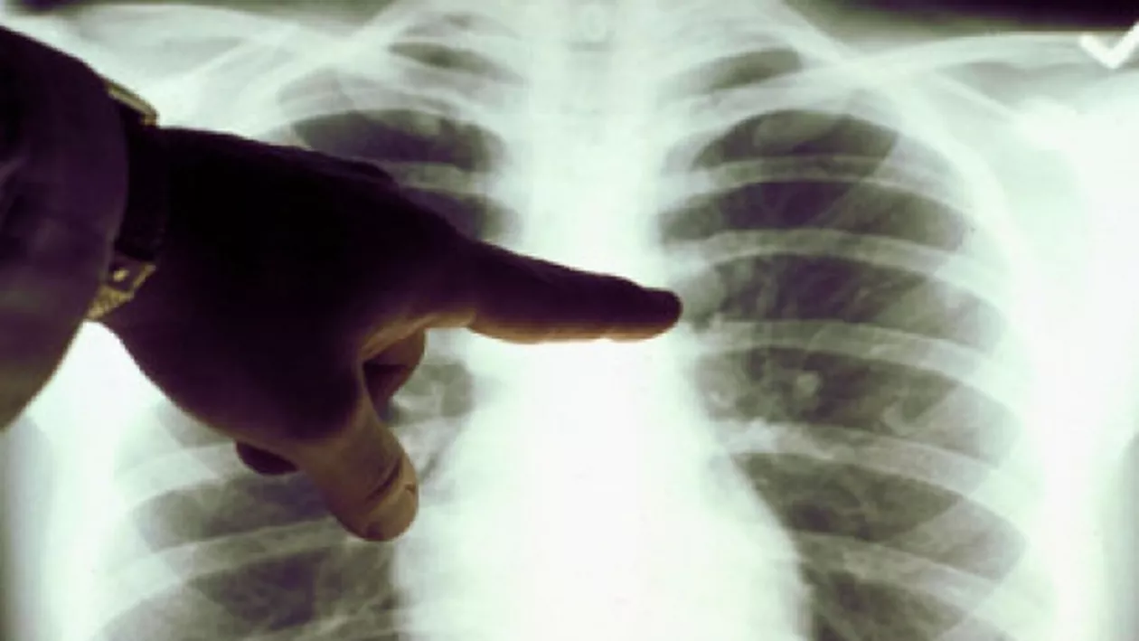 Profesoară care predă la două licee din Constanța, diagnosticată cu tuberculoză