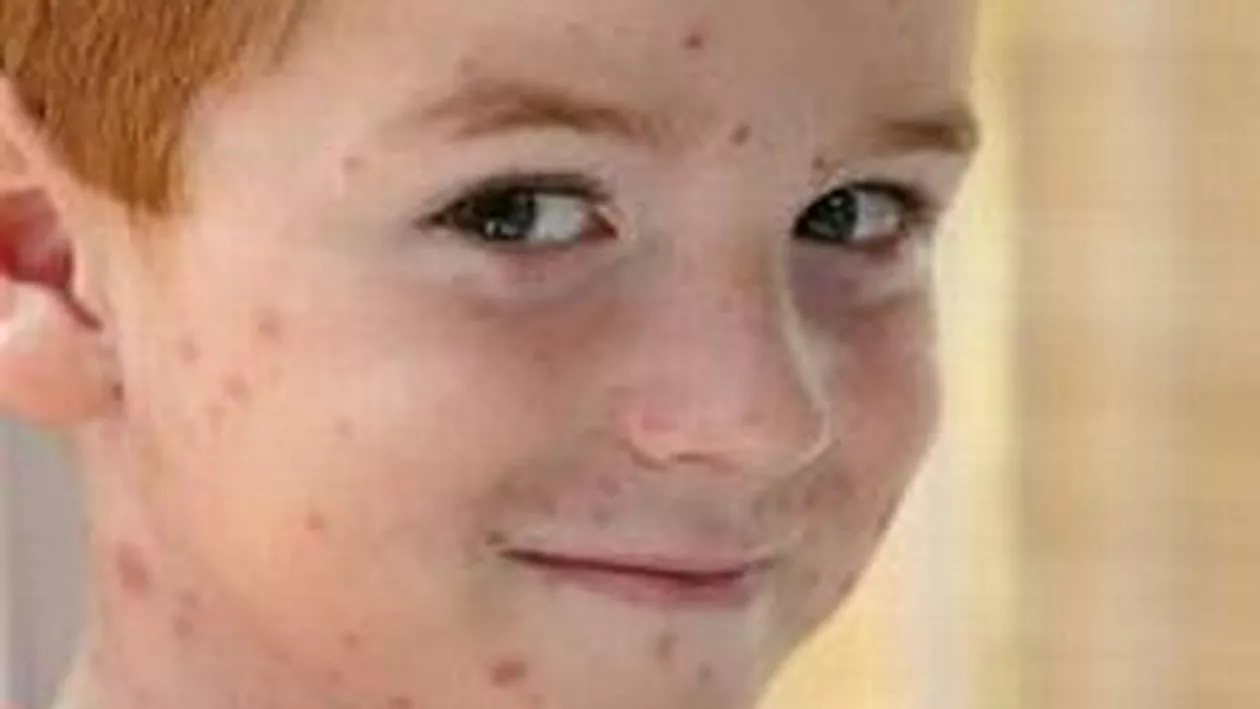 Un nou focar de varicelă, în Vaslui: 189 de copii s-au îmbolnăvit în această iarnă