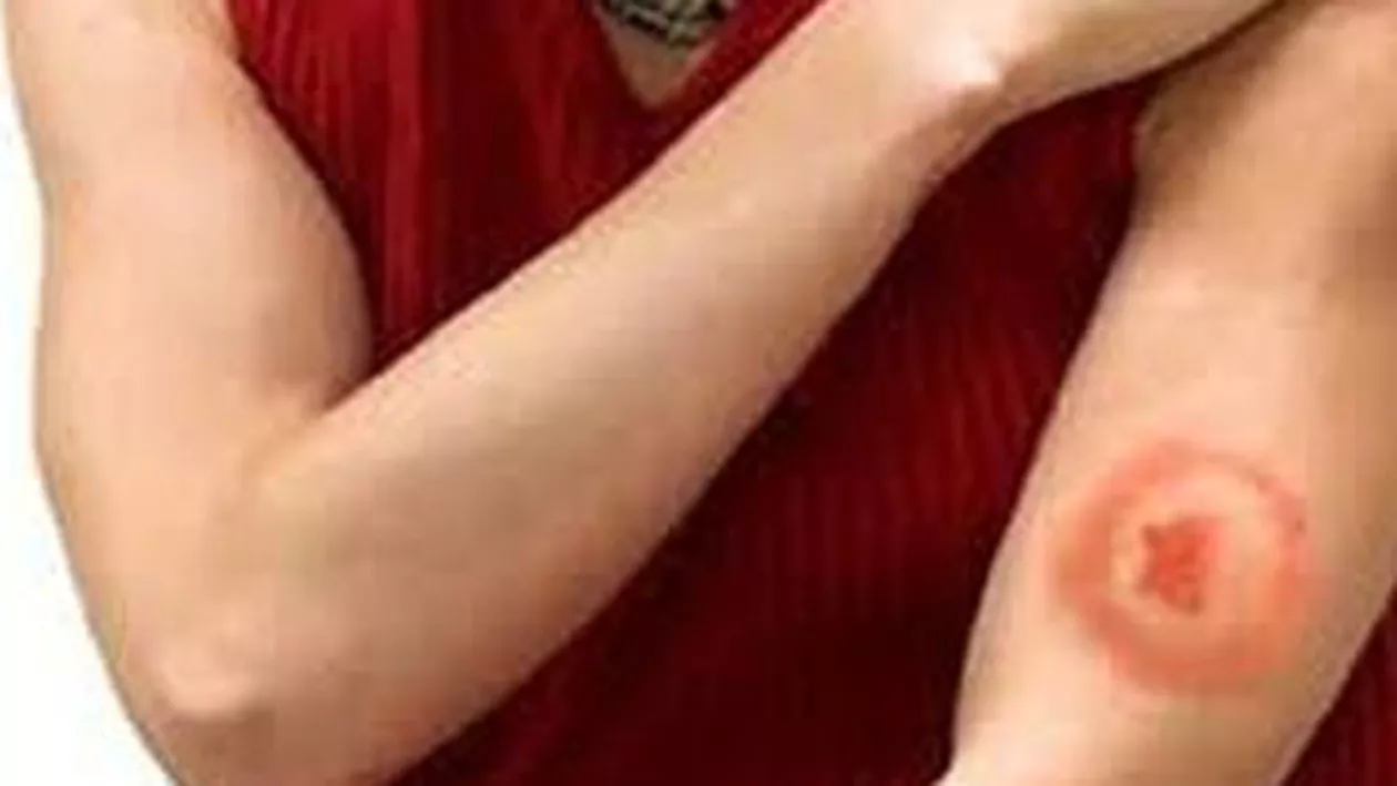 DSP Sibiu: 16 cazuri de boală Lyme, confirmate de la începutul anului la persoane înţepate de căpuşe