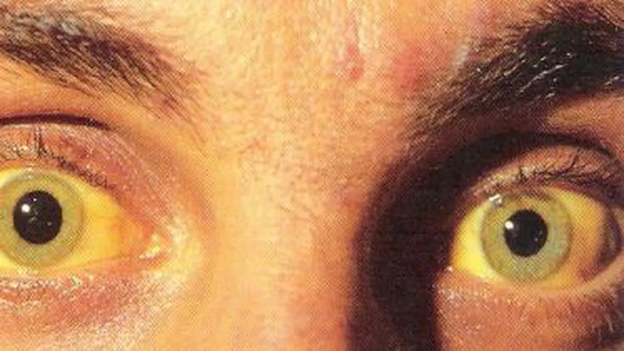 Planul strategic de acțiune împotriva hepatitelor din România a fost lansat la Timișoara: România are cea mai mare prevalență a hepatitelor B și C