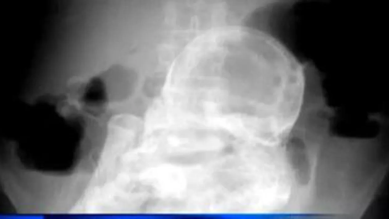 Brazilia: O femeie a stat timp de 44 de ani cu un fetus mort în burtă