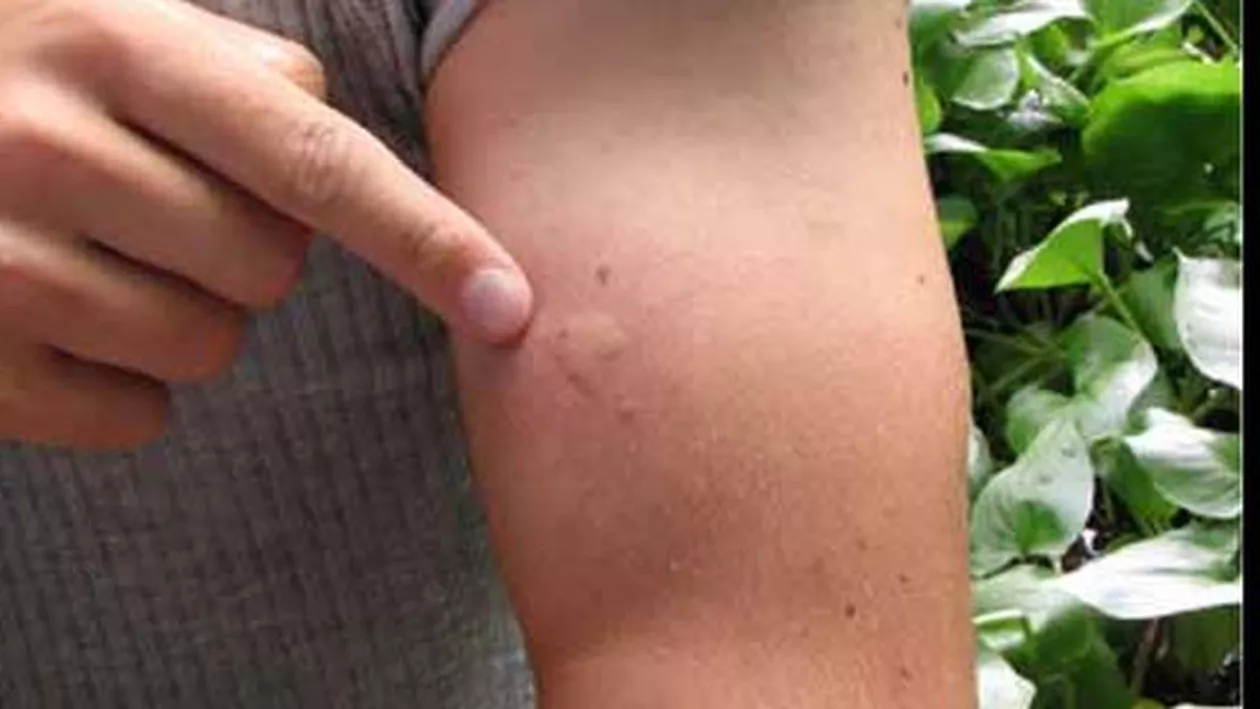 Buzău: Două cazuri de meningită cu virus West Nile, confirmate, iar al treilea există suspiciuni