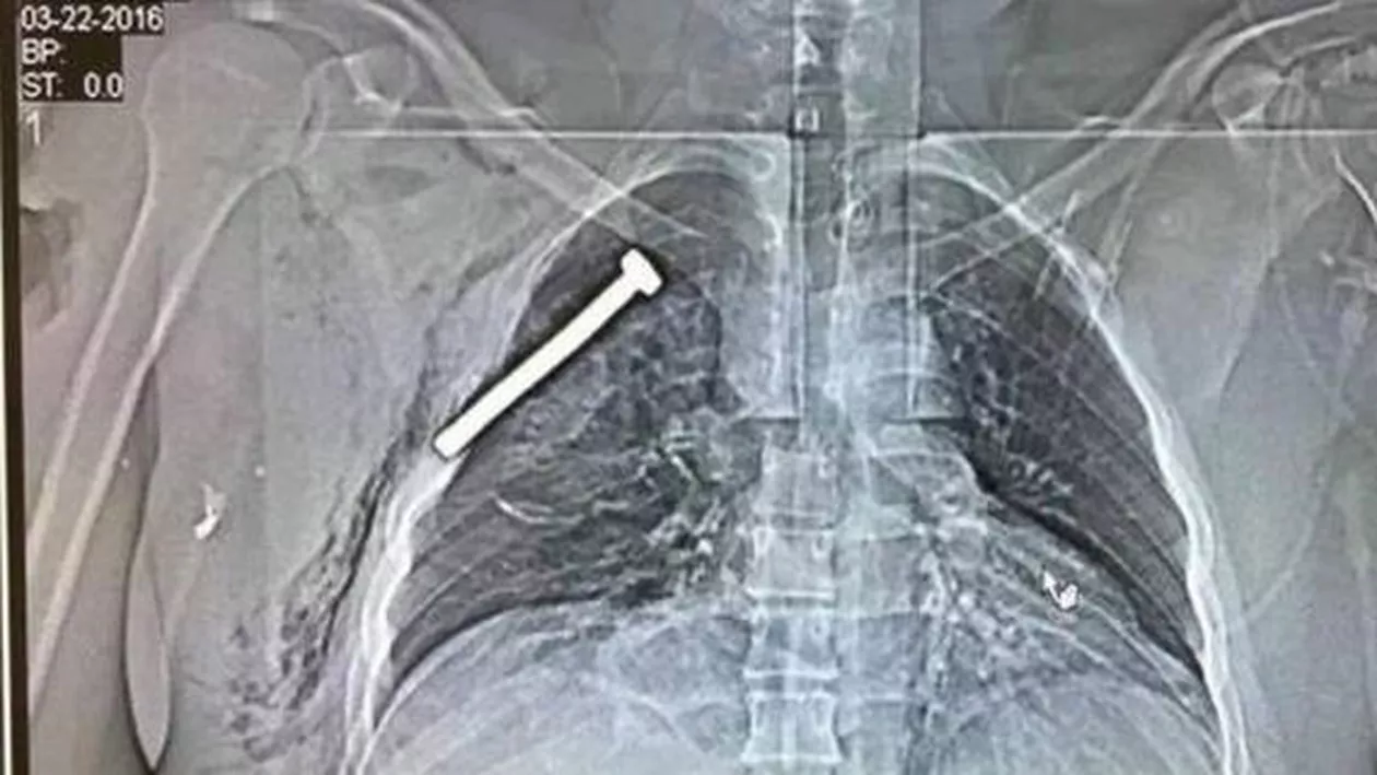 Un cui a fost găsit în pieptul unei persoane care a fost rănită în atentatele de la Bruxelles