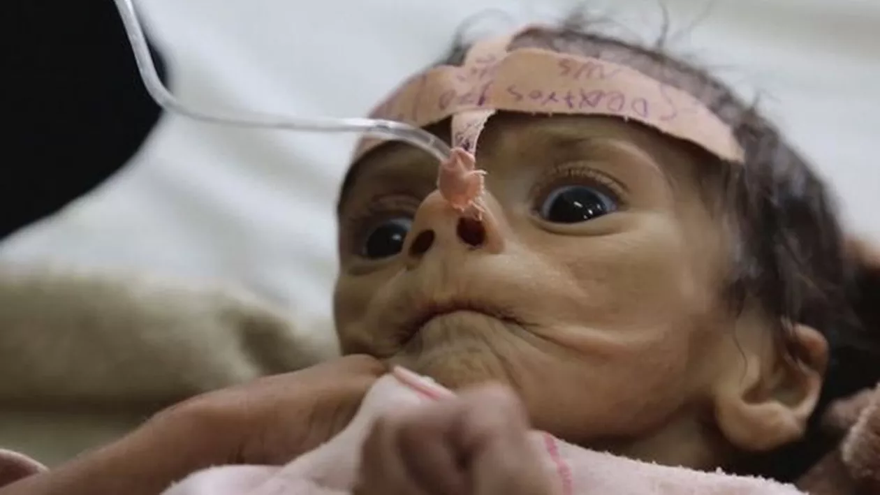 Un băiețel din Yemen de doar cinci luni a murit din cauza malnutriției severe: Nu a plâns și nu a avut nici o lacrimă, doar a încremenit. Am țipat și am leșinat (VIDEO)