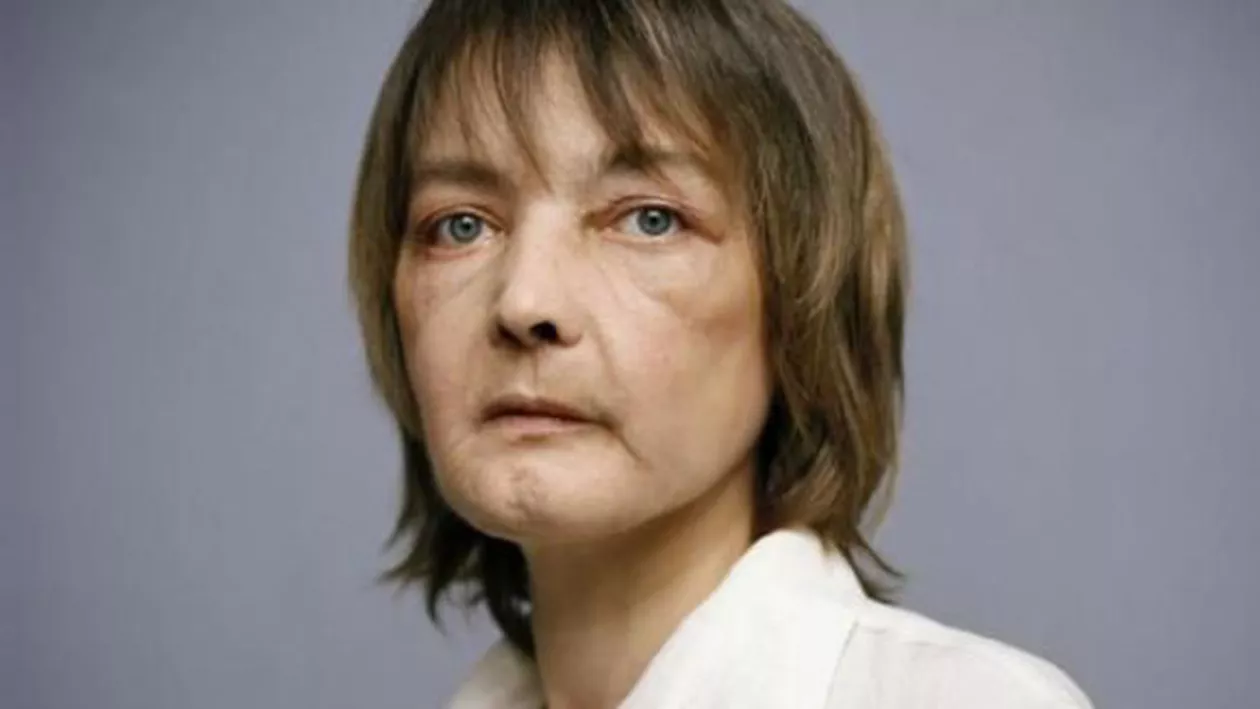 Beneficiara primului transplant de față din lume a murit de cancer