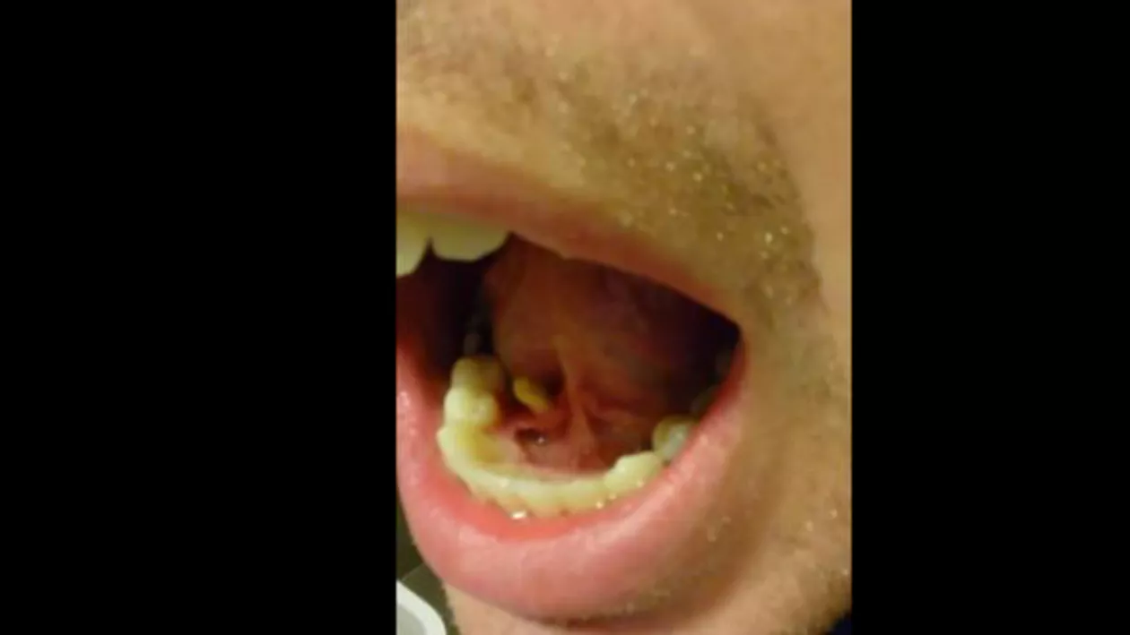 Imaginile care au șocat internauții: De ce boală suferă un american, după ce a descoperit că are o protuberanță sub limbă (VIDEO)