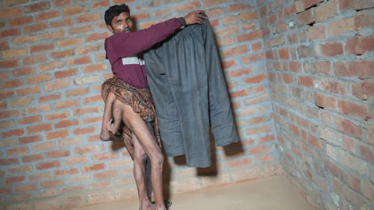 Imagini șocante: Un tânăr indian s-a născut cu două picioare în plus. Acesta imploră medicii să-l ajute să ducă o viață normală (FOTO)