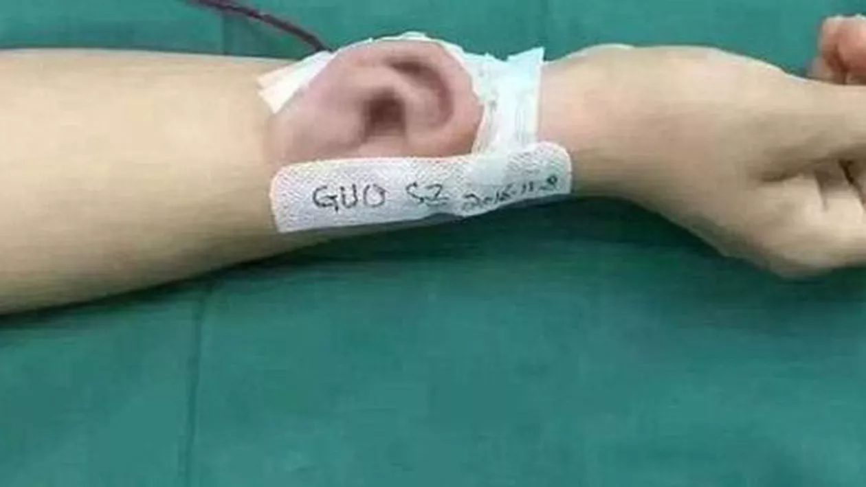Incredibil! Medicii au reușit să crească o ureche pe mâna unui bărbat (FOTO)