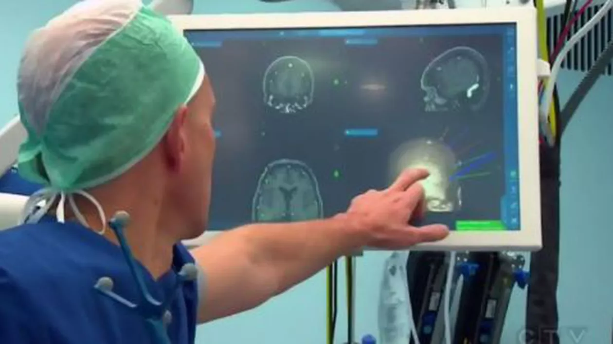 S-a realizat primul IMPLANT în creier din lume. Pacienta care a beneficiat de tehnologia revoluționară se simte bine