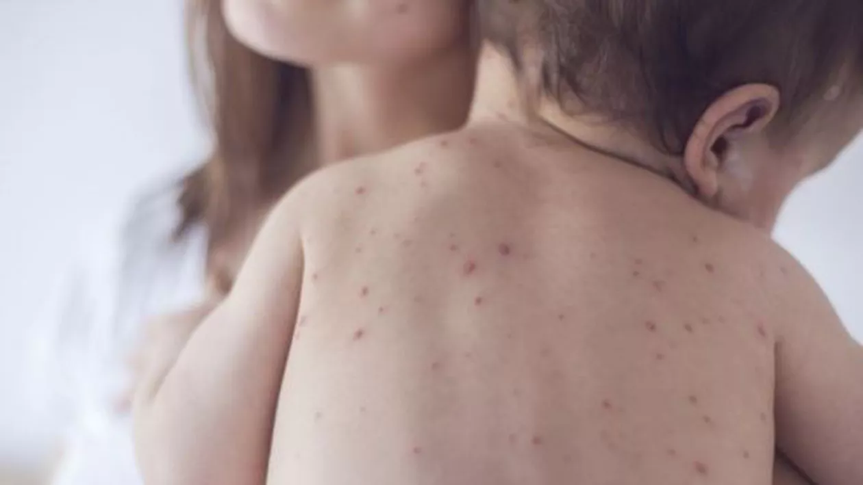 RUJEOLA a mai făcut o victimă: Numărul copiilor care au murit din cauza bolii a ajuns la 15