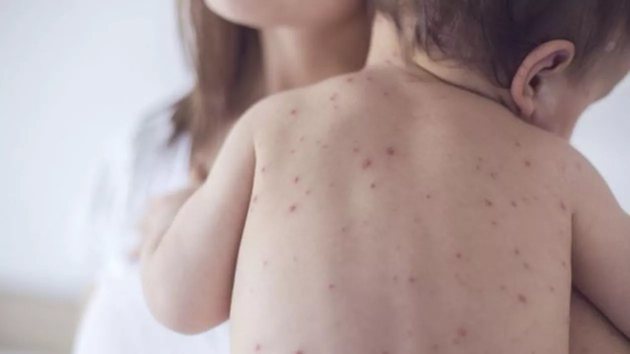 26 DE COPII MORȚI DIN CAUZA RUJEOLEI: Guvernul combate epidemia CU VORBE