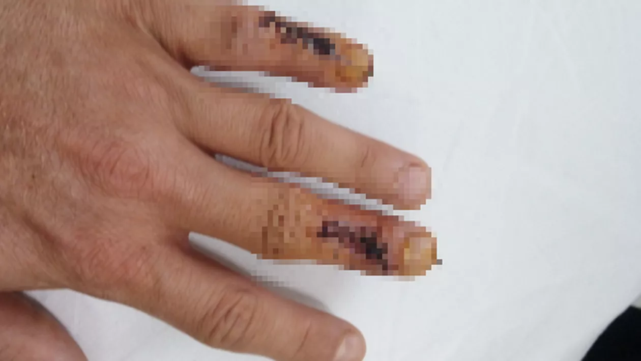 HALUCINANT! Un tânăr din Cluj a fost operat la degetul greșit. Medicul, total DEZINTERESAT (FOTO)