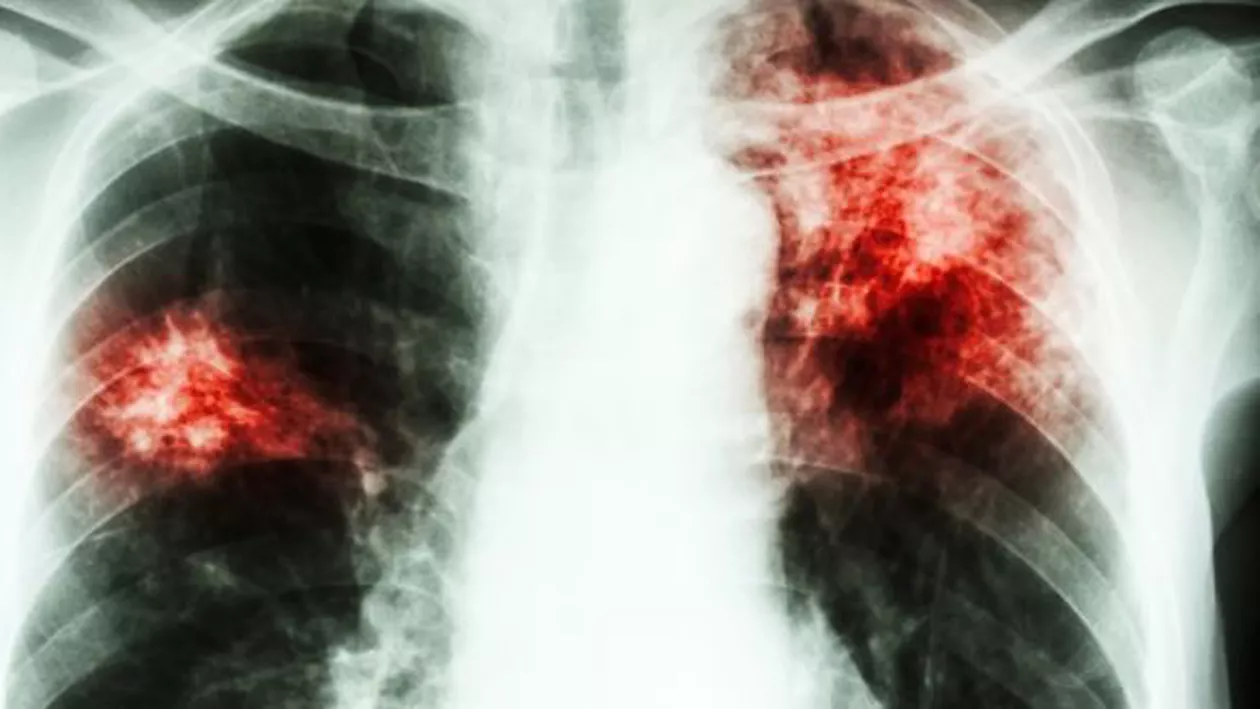 Cod ROȘU de TUBERCULOZĂ: Lipsesc peste 50% din medicamentele necesare tratamentului!  