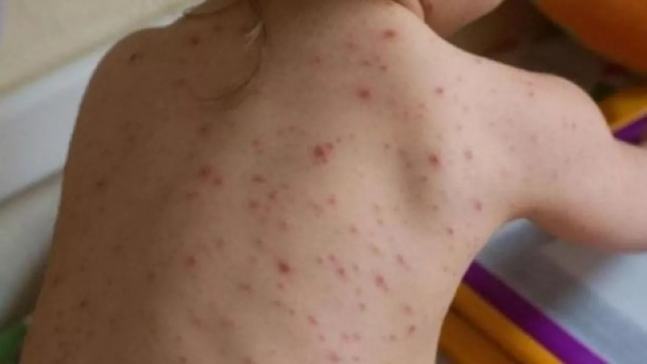 ALARMANT! Încă DOI COPII AU MURIT DIN CAUZA RUJEOLEI. Bilanțul deceselor este îngrijorător