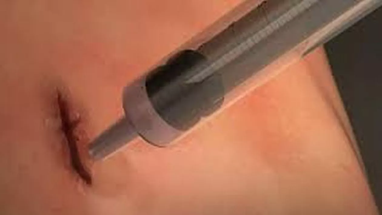 REVOLUȚIE ÎN MEDICINĂ! A fost creat GELUL care închide orice rană deschisă, fără cusături