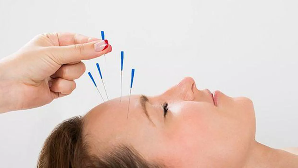 ACUPUNCTURA, O SOLUTIE PENTRU INSOMNII?
