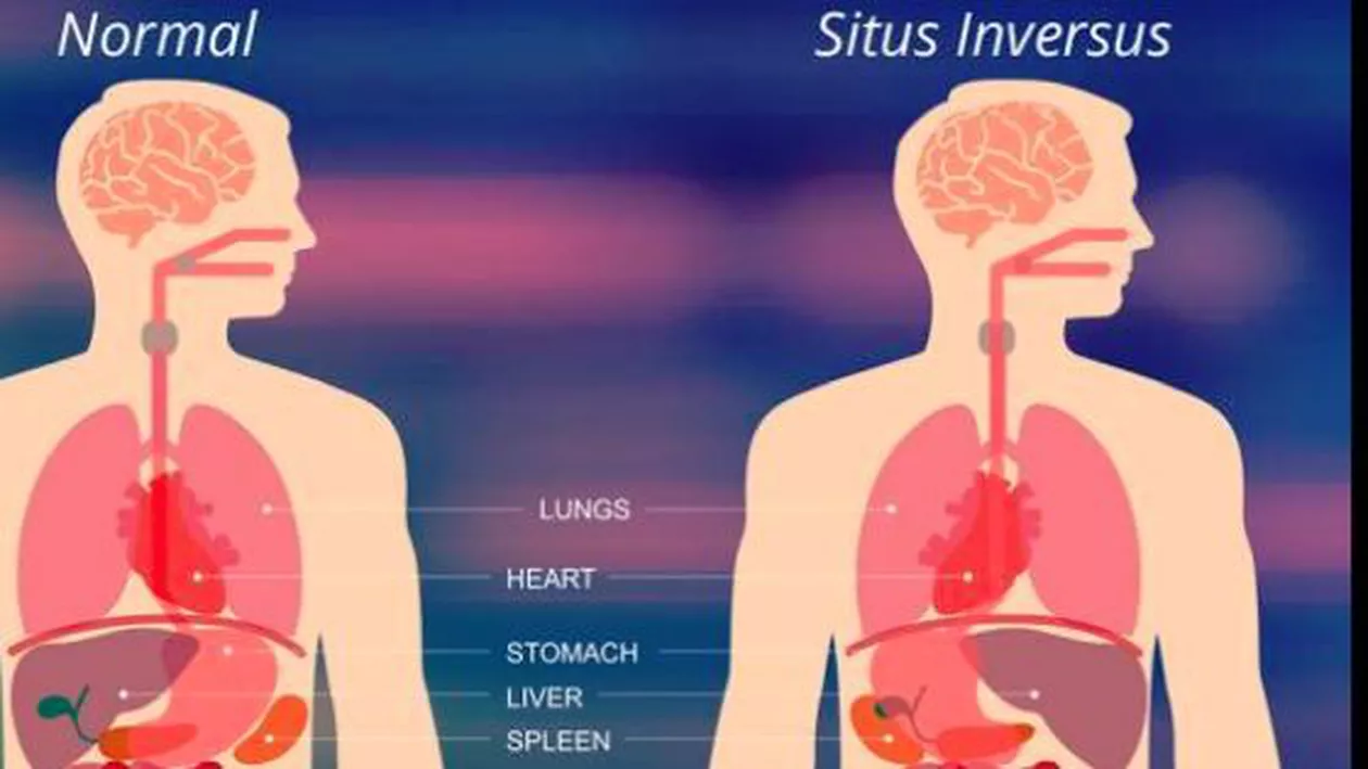 Femeie cu organele interne dispuse invers, operată la Spitalul din Suceava