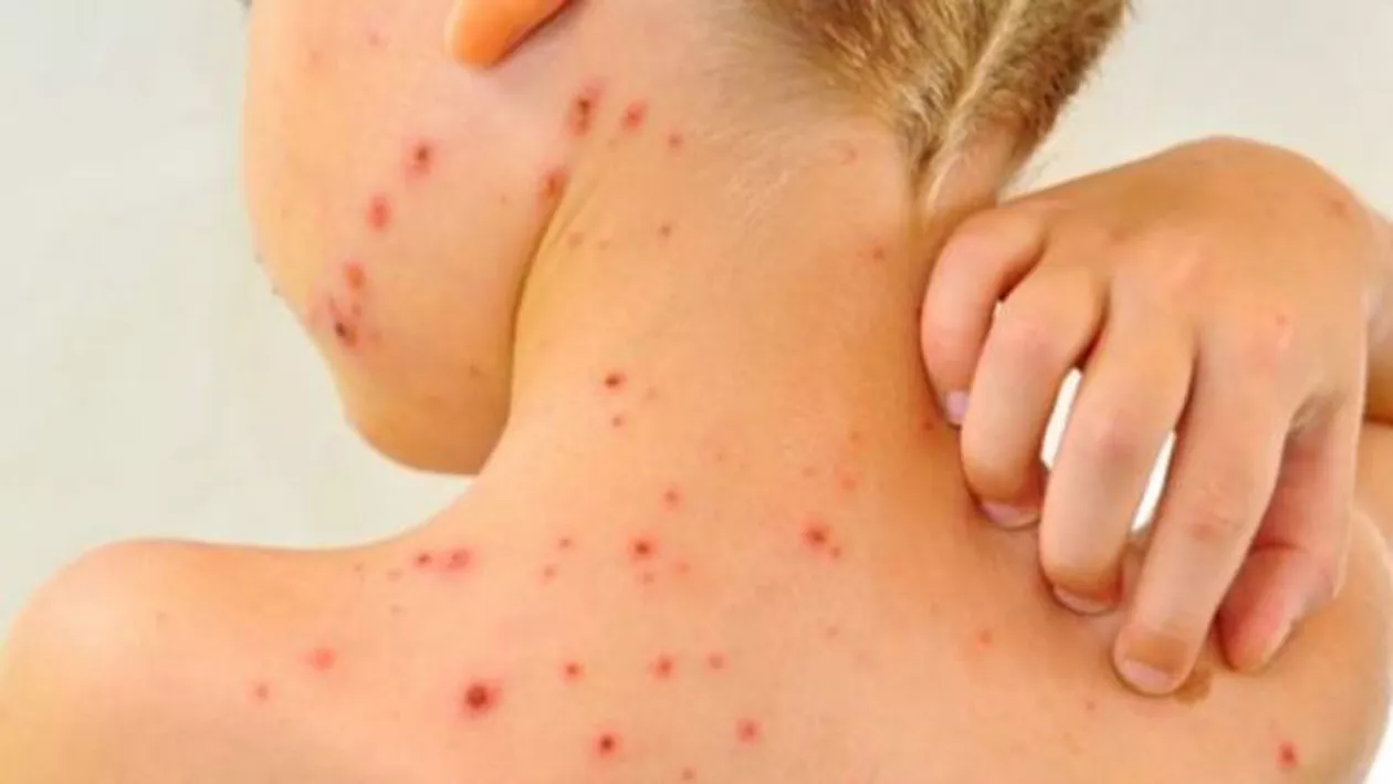 Epidemia de rujeolă continuă să se extindă: Autoritățile au făcut anunțul îngrijorător 