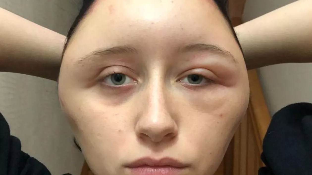 Caz ȘOCANT: A fost la un pas de moarte după ce și-a vopsit părul! Cum a fost posibil (FOTO)