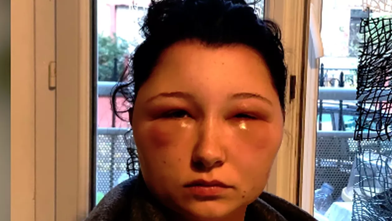 Clipele de GROAZĂ prin care a trecut o tânără, după ce s-a vopsit singură. A rămas DESFIGURATĂ: „Aveam impresia că mă transform în borcan”