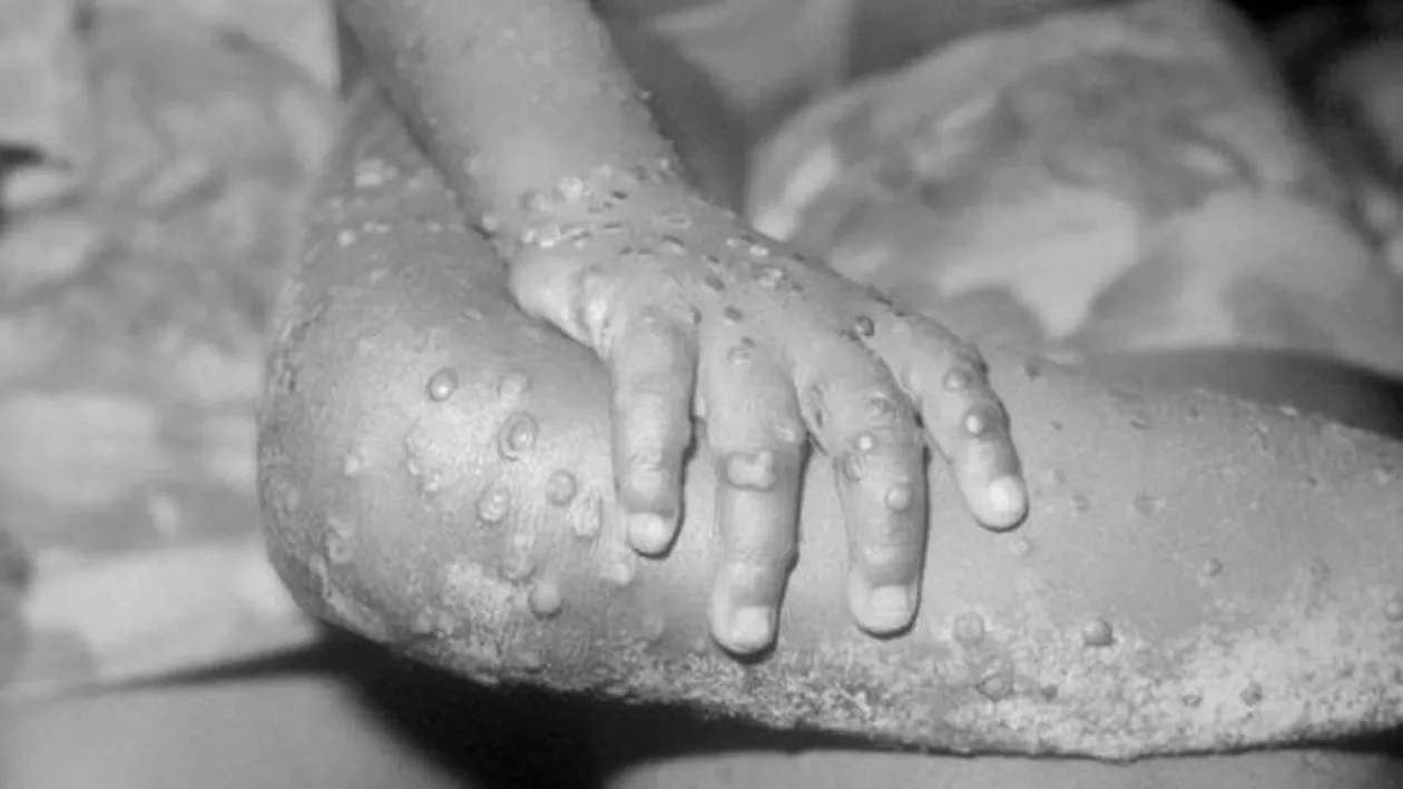 ALERTĂ în Anglia! O persoană a adus din Africa un SUPERVIRUS MORTAL