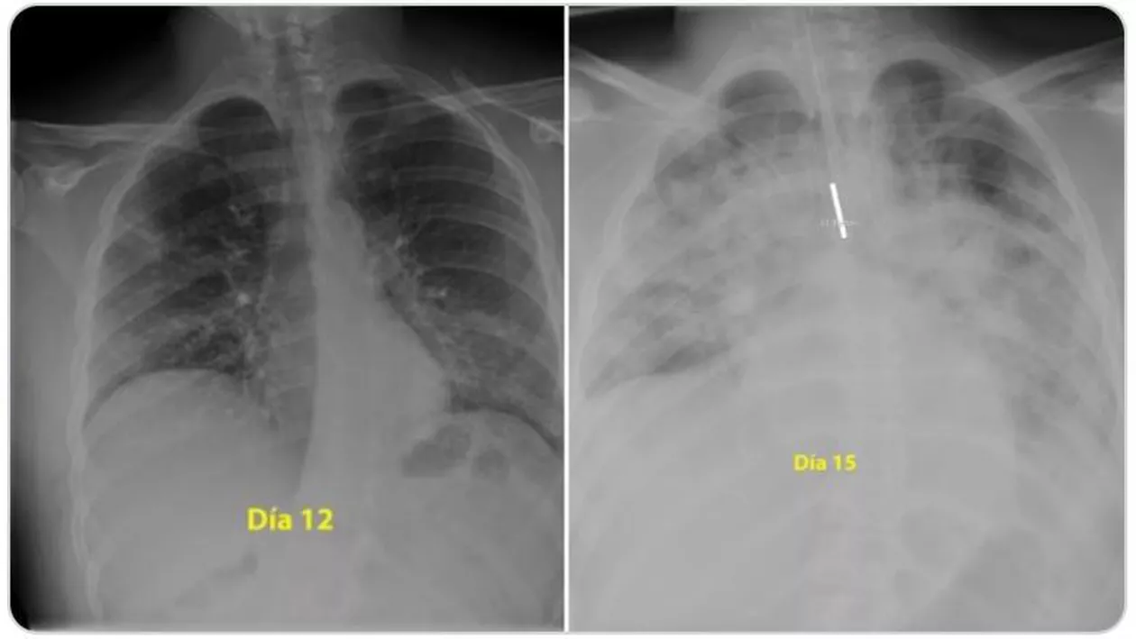 Cum arată plămânii unui tânăr infectat cu noul coronavirus: La 28 de ani a fost intubat în trei zile (FOTO)