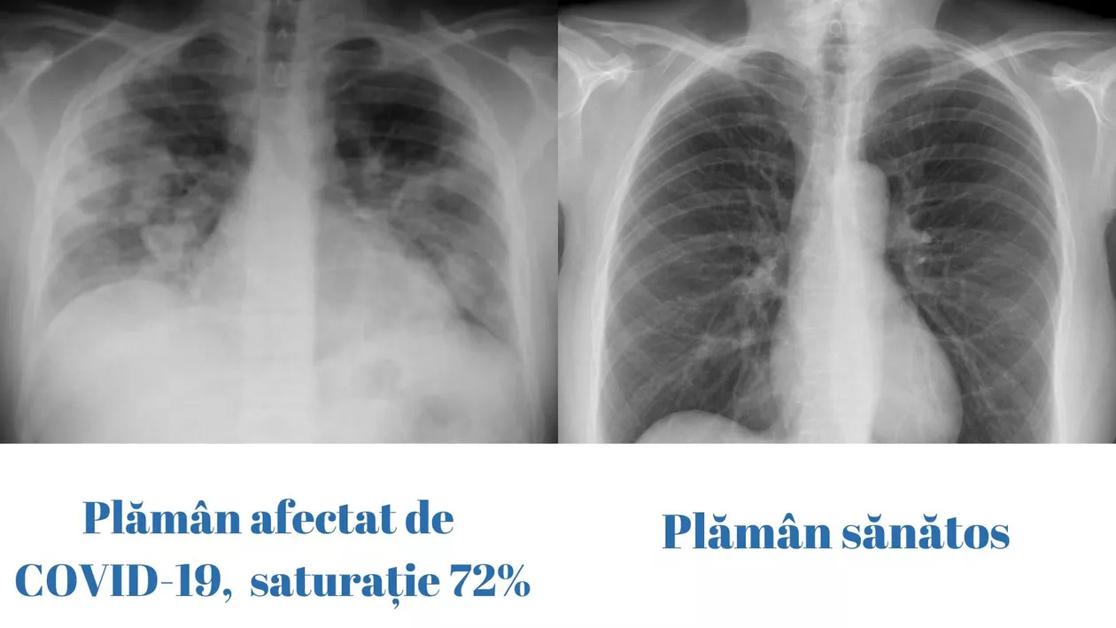 Diferenţa dintre un plămân sănătos şi unul afectat de COVID, cu saturaţie de 72%, la un pacient de 23 de ani