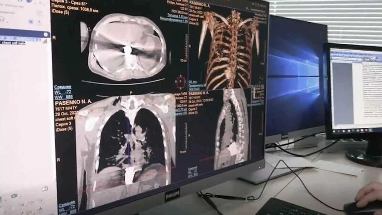 Intervenție chirurgicală complicată în Rusia pentru extragerea unei bombe neexplodate dintre coastele unui soldat participant la invazia Ucrainei
