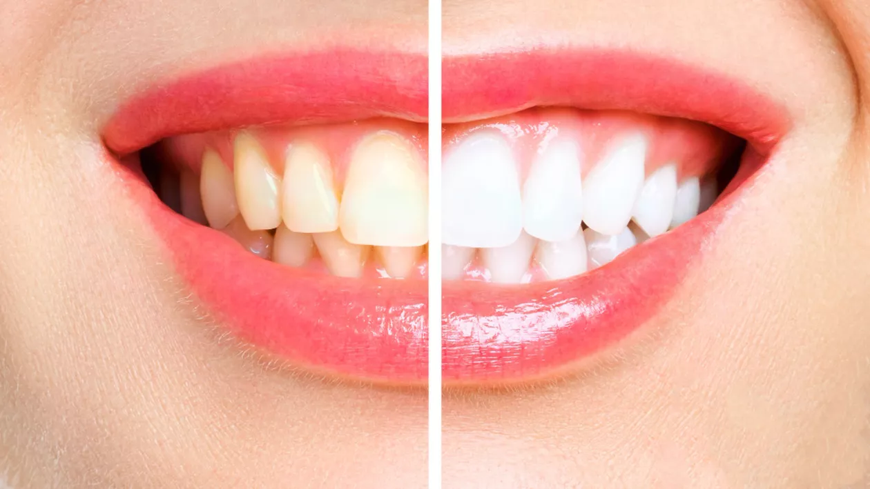 Care sunt diferențele dintre restaurarea dentară și estetica dentară