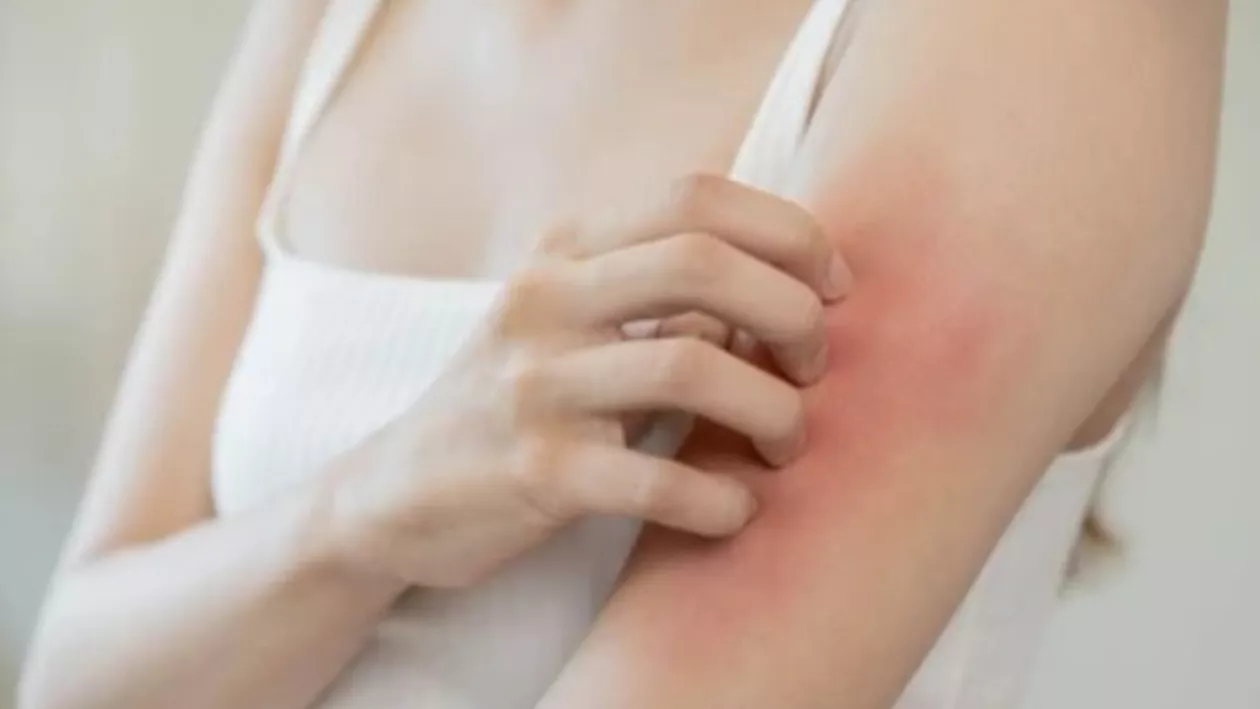 Cum tratezi iritaţia de la căldură / Sfaturile medicilor pentru zile caniculare