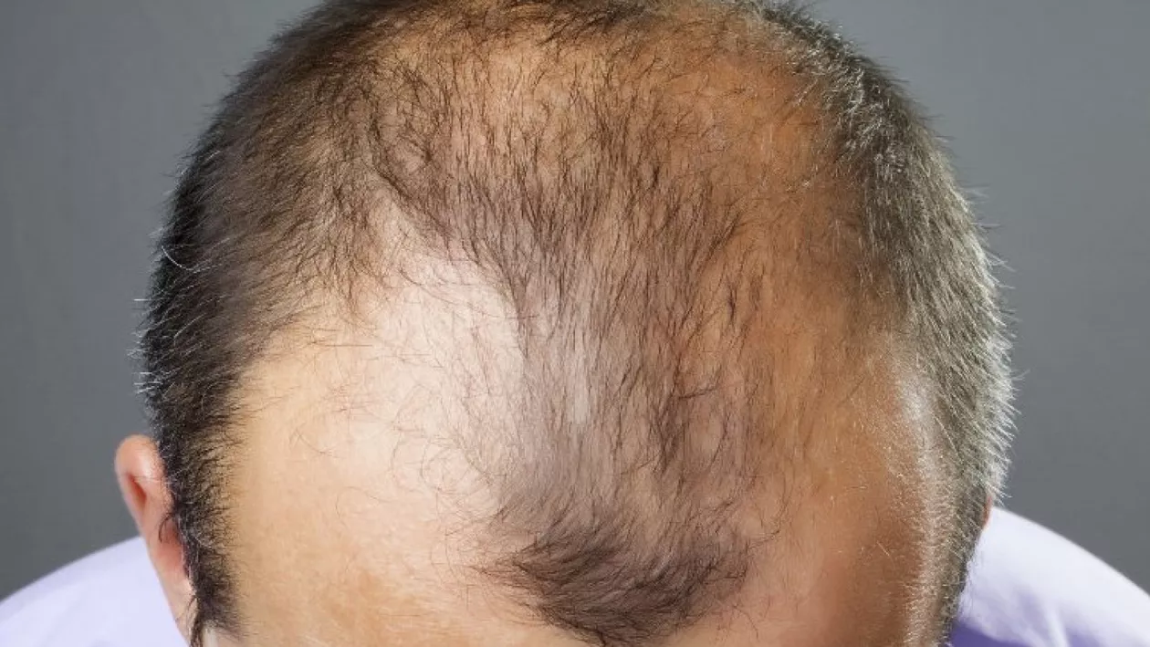 Îndulcitorul care ajută la creșterea părului. Descoperirea care dă speranțe bărbaților cu chelie