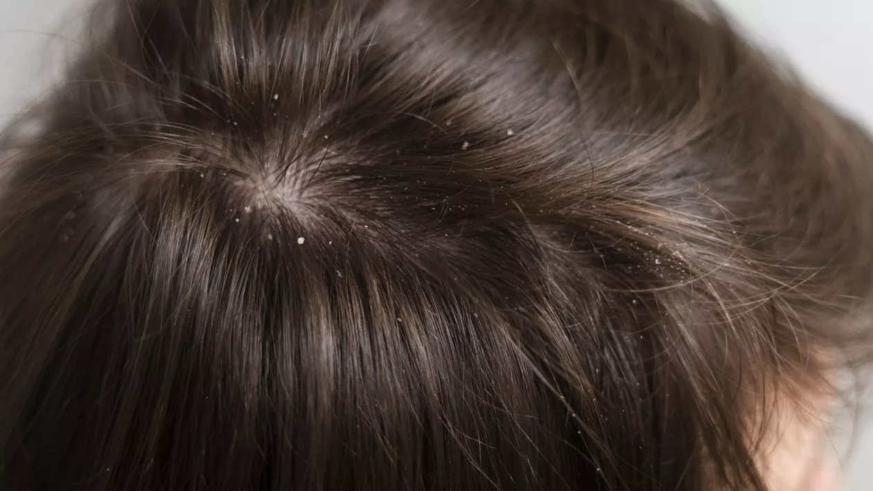 Scapă de mătreață cu o mască naturală! Rețeta simplă care chiar funcționează