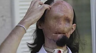 Statele Unite: Bărbat din Texas, supus unui transplant de față