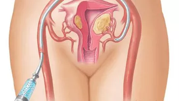 Embolizarea - abordare terapeutica noua in tratamentul fibromului uterin