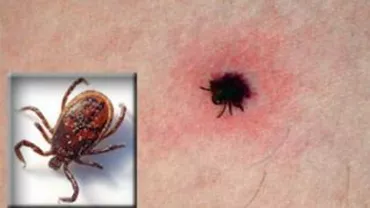 Primele victime ale căpușelor la Brașov: Cinci persoane au fost internate cu boala Lyme