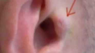 Un bărbat și-a implantat căști în ureche: Acum poate asculta muzică oricând și oriunde (VIDEO)