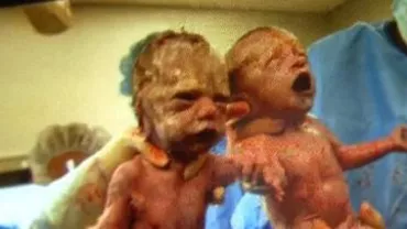SUA: Două surori gemene s-au născut ținându-se de mână (VIDEO)