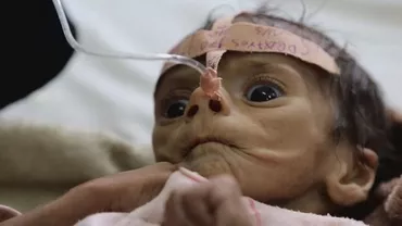 Un băiețel din Yemen de doar cinci luni a murit din cauza malnutriției severe: Nu a plâns și nu a avut nici o lacrimă, doar a încremenit. Am țipat și am leșinat (VIDEO)