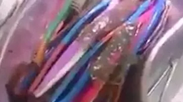 Operație incredibilă: Medicii au scos 18 periuțe de dinți și un tirbușon din stomacul unui pacient (VIDEO)