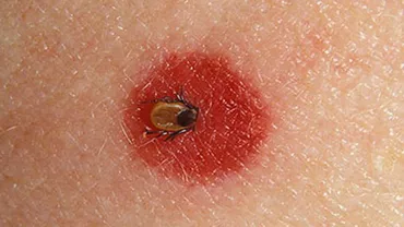 Alerta epidemiologică pentru boala Lyme, în Sibiu: Copiii între 5-9 ani, cei mai afectați