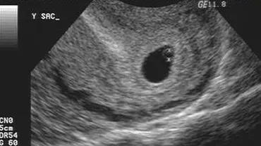 Caz șocant la Bacău. Sarcina unei femei, confundată cu un chist ovarian de către medic. Fătul, în pericol din cauza tratamentului