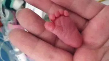 Cel mai mic bebeluș din lume a împlinit nouă luni! Emilia cântărea la naștere 226 de grame