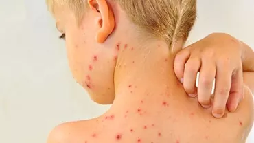 Rujeola face ravagii în țară. Numărul de cazuri confirmate a ajuns la 753 (VIDEO)