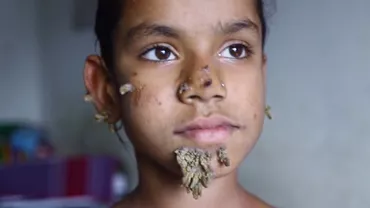 Caz INCREDIBIL: O fată din Bangladesh ar putea fi prima persoană de sex feminin cu sindromul omul-copac (VIDEO)
