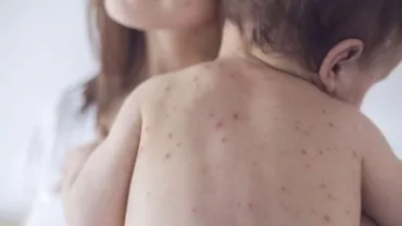 Belgienii dau vina pe România pentru explozia cazurilor de rujeolă din ţara lor (VIDEO)