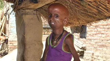 Povestea neobișnuită a unui tânăr de 21 de ani care arată ca un bătrân de 160 de ani (FOTO)