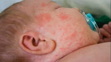 Al 25-lea COPIL MORT din cauza RUJEOLEI: "NU era vaccinat. S-a chinuit foarte mult"